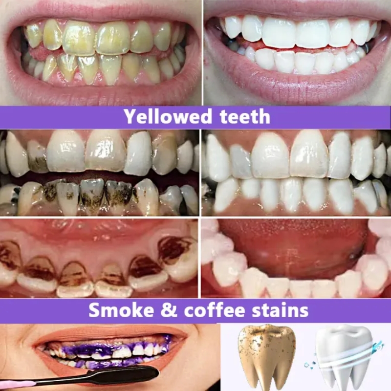 2026 Bestselling Whitening Too - đánh giá và giá Teeth Whitening Effective