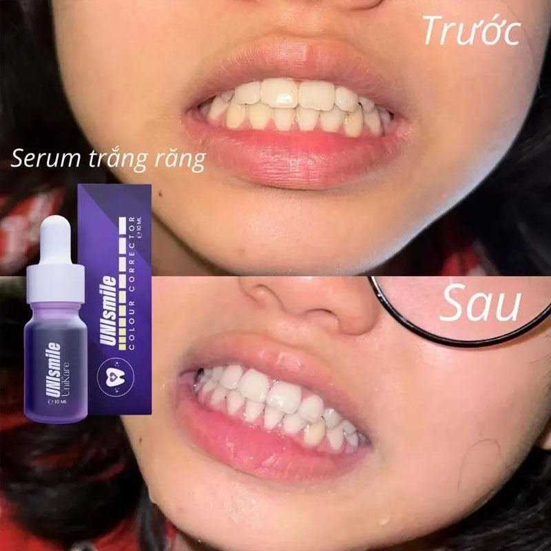 Unismile Teeth Whitening Essen - đánh giá và giá Teeth Whitening Effective