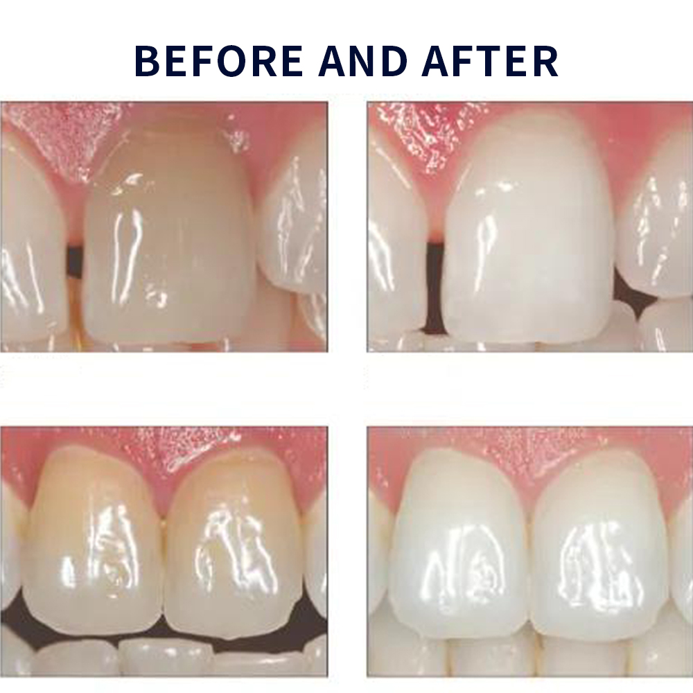 Opalescence Whitening 20% PF 2 - đánh giá và giá Teeth Whitening Foam