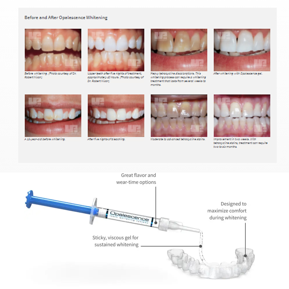 Opalescence Whitening 20% PF 2 - đánh giá và giá Teeth Whitening Foam